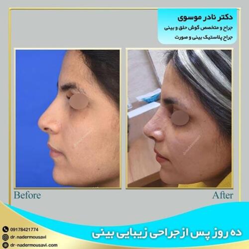 جراحی-زیبایی-بینی-30