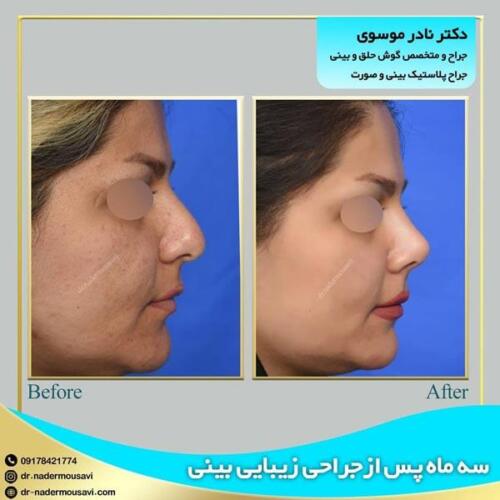جراحی-زیبایی-بینی-40