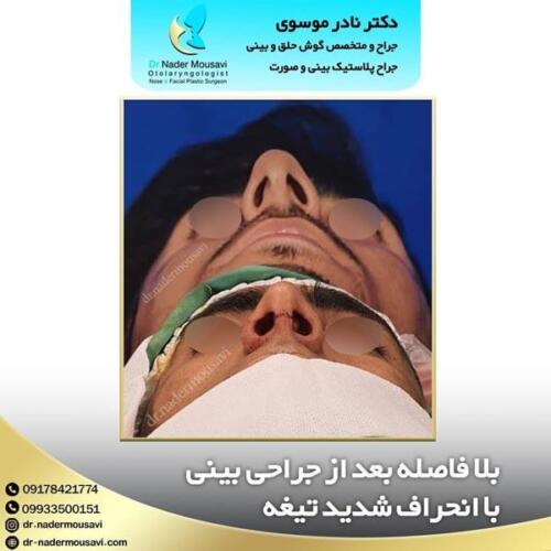 جراحی-زیبایی-بینی-48