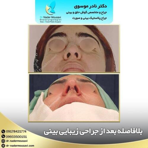 جراحی-زیبایی-بینی-58