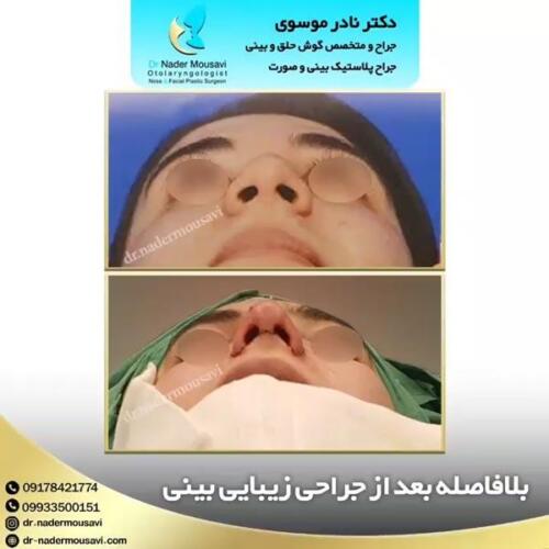 جراحی-زیبایی-بینی-59