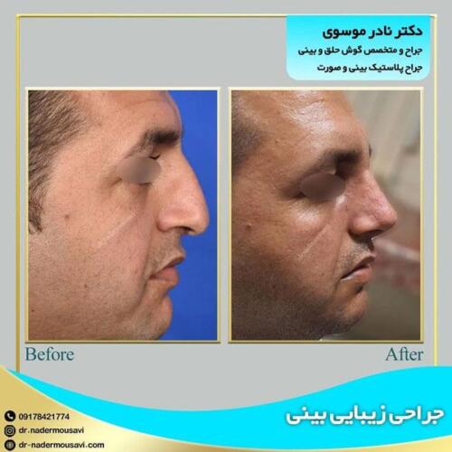 جراحی زیبایی بینی 21